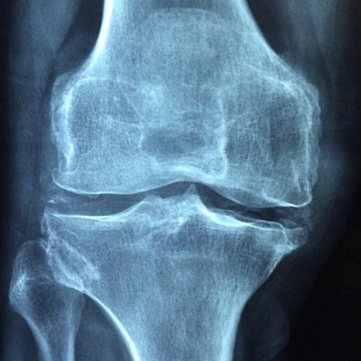 Osteoartritis - kako ga spriječiti